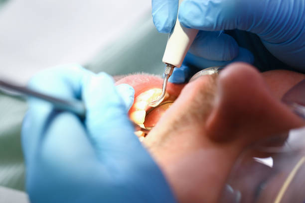 Best Emergency Dental Extractions in Lacey, WA